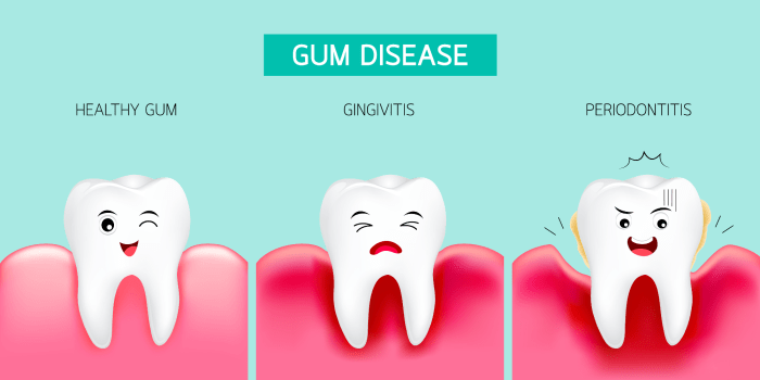 Disease periodontal dental gum teeth periodontitis hygiene oral health stages progression life diseases tooth calculus progress treatment types early school