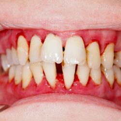 Gingivitis blurbs do disease periodontal