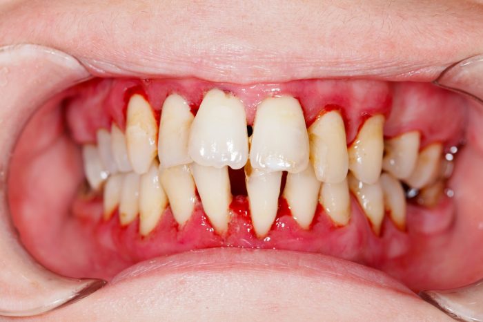 Gingivitis blurbs do disease periodontal